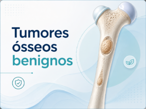 Tumores ósseos benignos Osteocondroma, encondroma, osteoma osteoide, cisto ósseo, displasia fibrosa e outras lesões benignas.